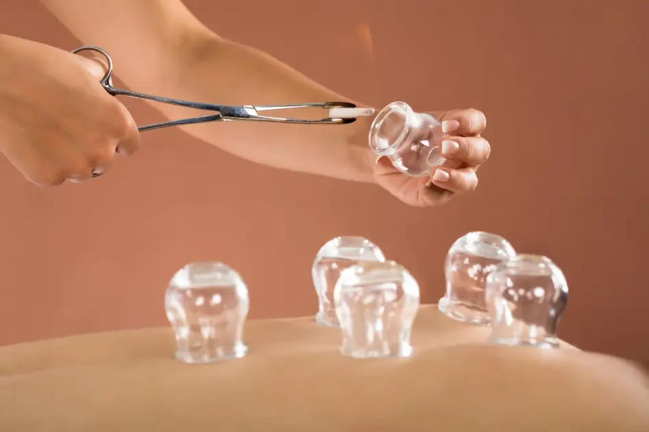 cupping